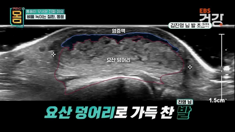 345.mp4_001237.762.jpg 30대 통풍 환자의 발상태 ㄷㄷㄷㄷ...jpg