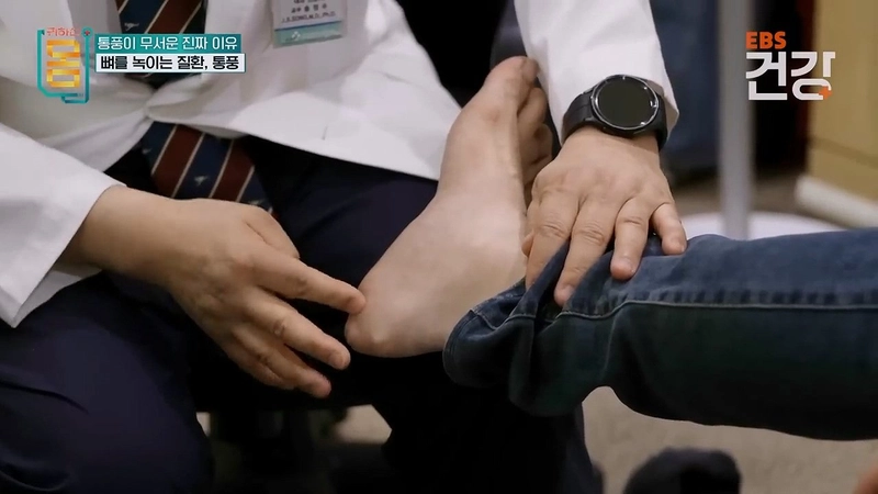 345.mp4_001143.974.jpg 30대 통풍 환자의 발상태 ㄷㄷㄷㄷ...jpg