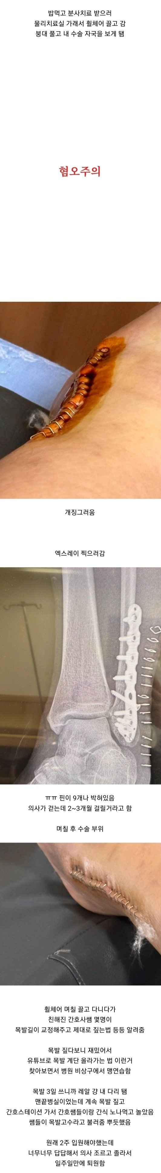 Internet_20231228_235854_2.jpeg 발목 부러졌는데 하나도 안아프다는 여자의 11개월 뒤 근황 ㄷㄷㄷ.JPG