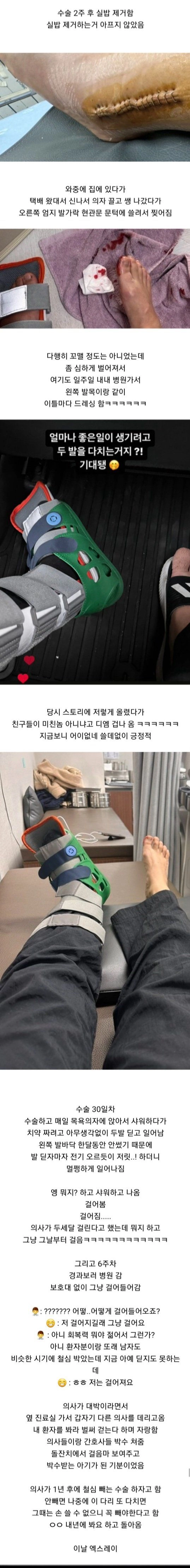 Internet_20231228_235854_3.jpeg 발목 부러졌는데 하나도 안아프다는 여자의 11개월 뒤 근황 ㄷㄷㄷ.JPG